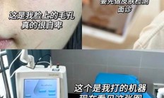 激光治疗毛孔粗大价格（激光治毛孔粗大靠谱吗）
